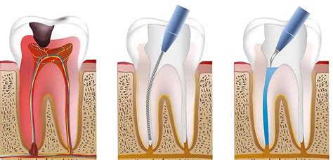 Things To Know Before A Root Canal Insights From Brentwood Dentists