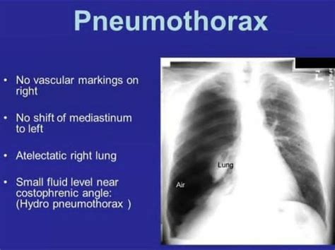 Pneumothorax MEDizzy