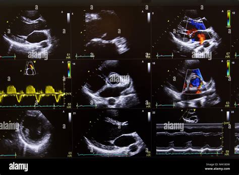 Imagen de ultrasonido del corazón en una pantalla de ordenador