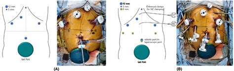 Laparoscopic Donor And Recipient Hepatectomy Followed By Robot‐assisted Liver Graft Implantation