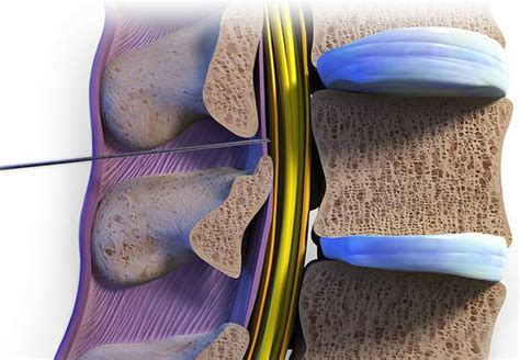 Caudal Epidural Steroid Injection Anatomy