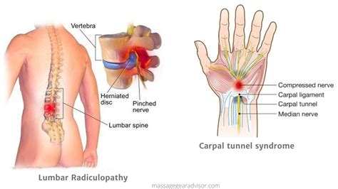 Can a Massage Gun Help a Pinched Nerve? » Massage Gear Advisor