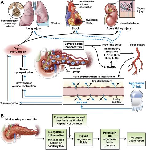 Optimum Fluid Therapy In Acute Pancreatitis Needs An Alchemist