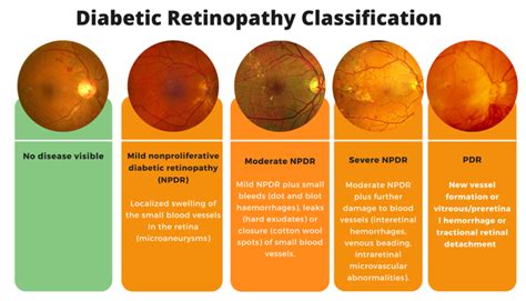 Diabetic Retinopathy Classification Medizzy