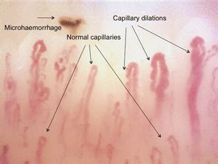 Primary Raynauds Phenomenon And Nailfold Videocapillaroscopy Age