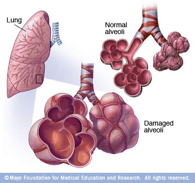 Emphysema Disease Reference Guide Drugs