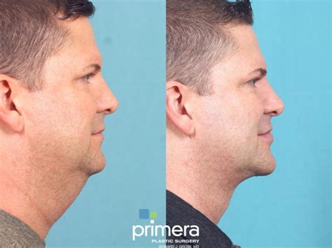 Submentoplasty Chin Implant Neck Lift Orlando Fl