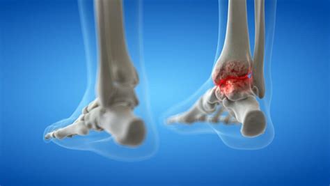 Ankle Fusion Surgery London Foot And Ankle