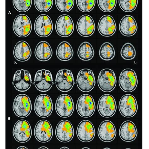 Brain Tumor Location By Sex A The Aggregate Map Of Brain Tumor Download Scientific Diagram