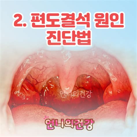 편도결석 빼는법 증상 원인 수술방법 예방법으로 관리해요 A2