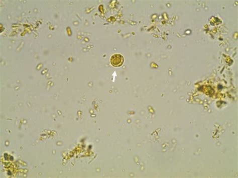 Blastocystis Hominis Histology