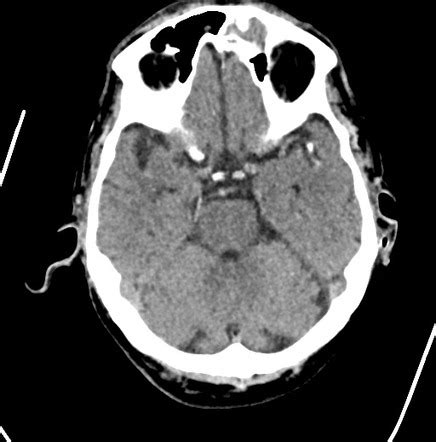 Left Middle Cerebral Artery Territory Infarct Calcified Embolus