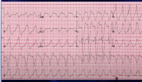 Emergency Med ACLS Flashcards Quizlet