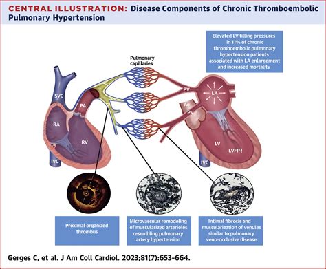 Left Ventricular Filling Pressure In Chronic Thromboembolic Pulmonary