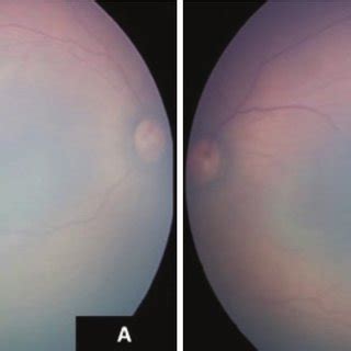 Color Fundus Photographs Of The Right A And Left B Eye After Laser