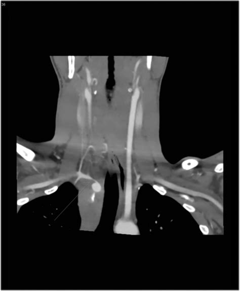 Ct Arteriogram Demonstrating Injury To Proximal Right Subclavian Artery Download Scientific