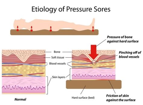 Pressure Ulcers - Home