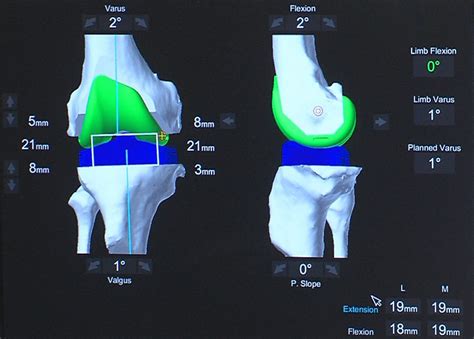 Mako Precisi N Humanoide En Artroplastia De Rodilla Efe Salud