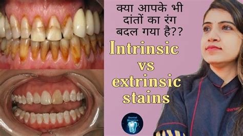 Extrinsic Stains Vs Intrinsic Stains Discoloration Of The Teeth Dental Stains Discoloring