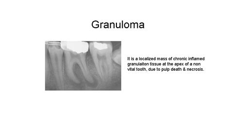 Periapical Pathology Pap Periapical Abscess Granuloma Periodontal Cyst