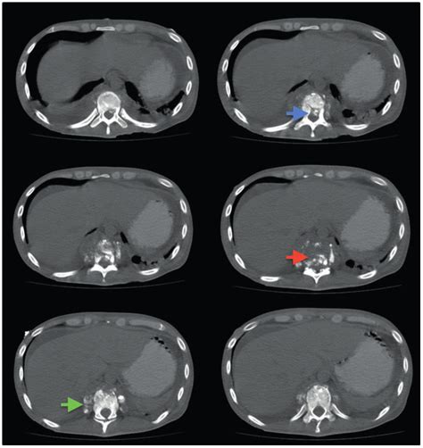 Chest CT Scan T10 And T11 Vertebral Destruction Red Arrow With A