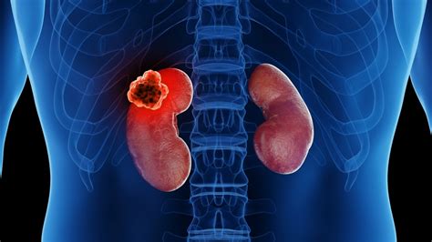 Metastatic Renal Cell Carcinoma | Dr. Sandeep Nayak