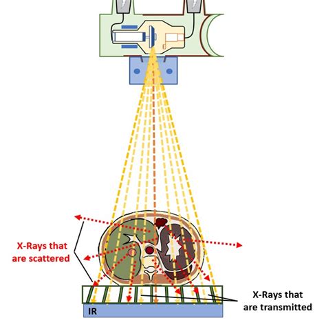 Grids And Beam Restriction Digital Radiographic Exposure Principles