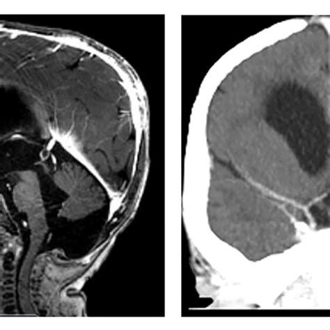 | MPS I prior to stroke. (Left) MRI Head demonstrating imaging findings... | Download Scientific ...