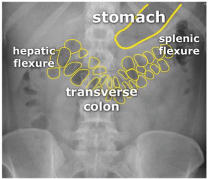 Abdominal X Ray Interpretation Small Large Bowel Obstruction