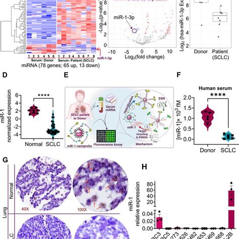 Microrna Profiling In Sclc Patient Serum Identifies Mir P Mir Is