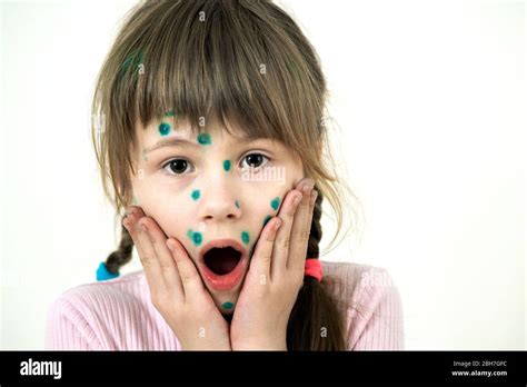 Child Girl Covered With Green Rashes On Face Ill With Chickenpox