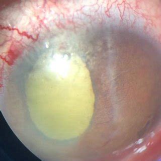 Anterior Segment Image Of Left Eye Showing Shallow Anterior Chamber