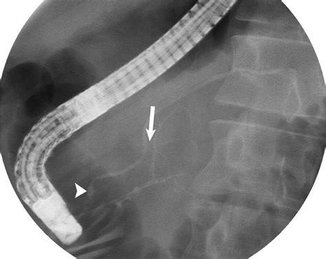 References In Endoscopic Retrograde Pancreatography Clinical