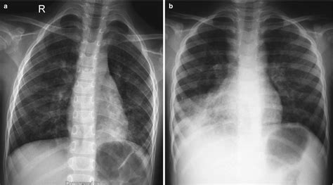 Mycoplasma pneumonia chest x ray findings - varspa