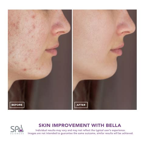 Spa Sciences Bella Wetdry Diamond Microdermabrasion And Pore Extraction