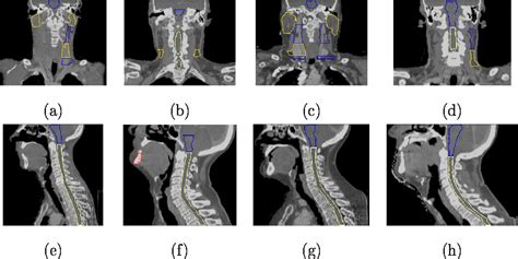 Table 1 From Atlas Based Delineation Of Lymph Node Levels In Head And