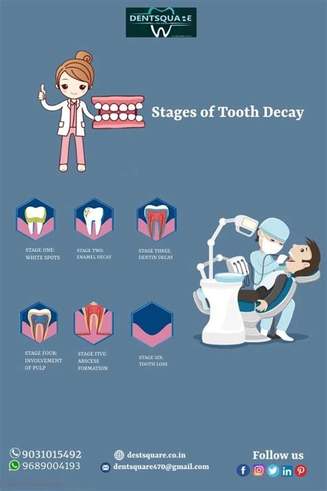 Stages of tooth decay – Artofit