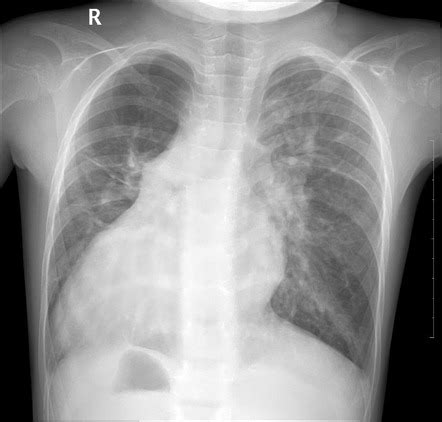 Situs inversus | Radiology Case | Radiopaedia.org