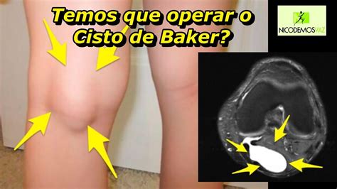 Temos Que Operar O Cisto De Baker Youtube