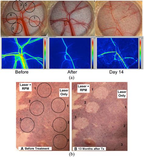 Combined PDL Therapy With Rapamycin Induces Persistent Vascular