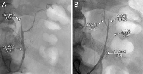 -Venogram of the left inferior phrenic (A) and adrenal central veins ...