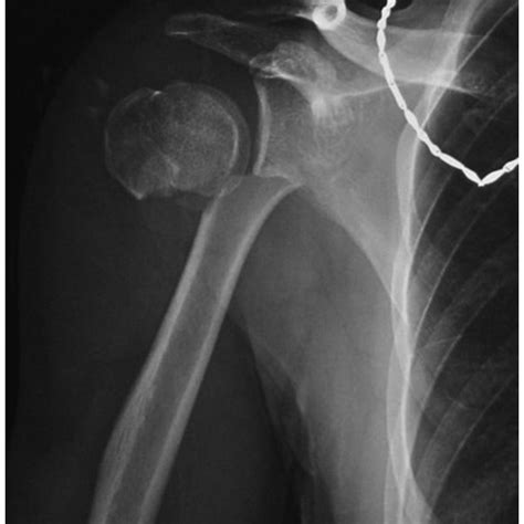 Upper Humerus Fracture