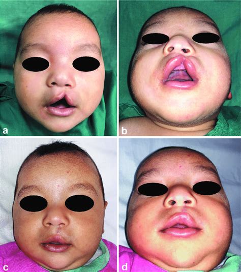 A Case Of Fishers Group 4 Month Old Male With Left Sided Unilateral