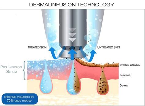 Dermalinfusion Facial - Essex Body Sculpture | fat freezing essex