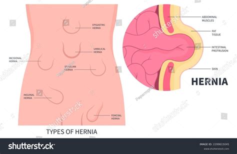 Various Types Hernia On Abdominal That Stock Vector (Royalty Free ...