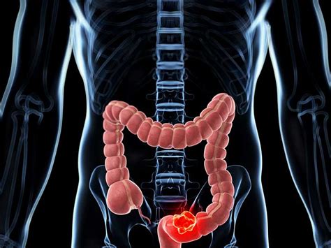 Colonic (Colorectal) Polyps: Causes, Symptoms, and Diagnosis