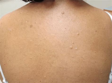 Multiple Smooth Flesh Colored Papules On Back Download Scientific Diagram