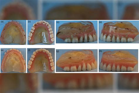 Denture Stomatitis An Interdisciplinary Clinical Review News