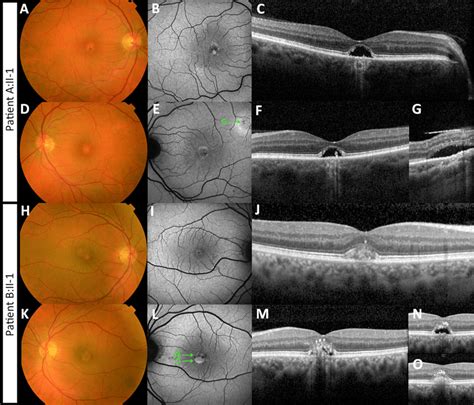 Multimodal Imaging Of Two Patients With Adult Onset Vitelliform Macular Download Scientific