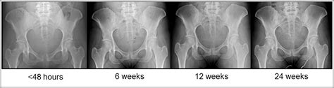 Pubic Symphysis Separation And Regression In Vaginal Versus Cesarean Delivery Journal Of